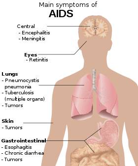 عوارض ایدز